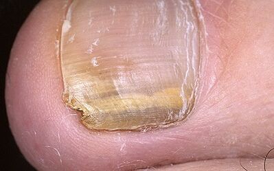Fungus manifestations on the big toe