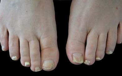 How to get rid of fungi on fingers