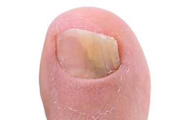 Symptoms of the presence of the fungus on the big toe