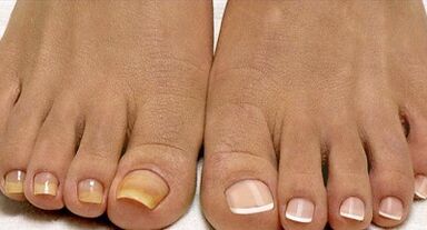 Methods of Treating Flot Fungi