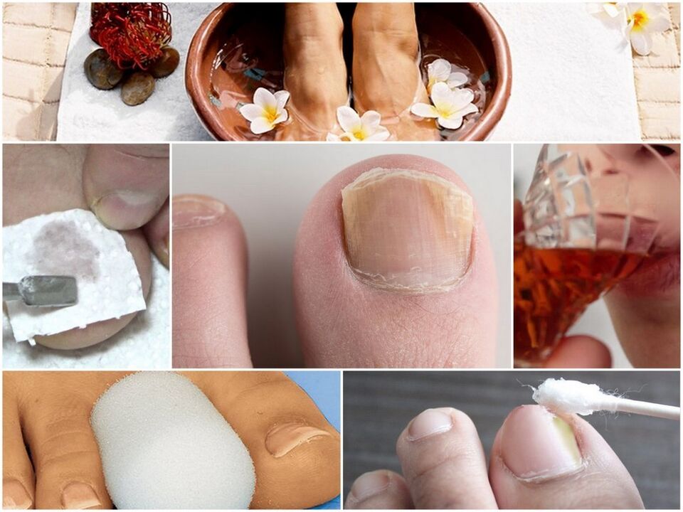 Treatment of nail fungus