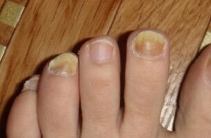 nail yellowing due to mushrooms