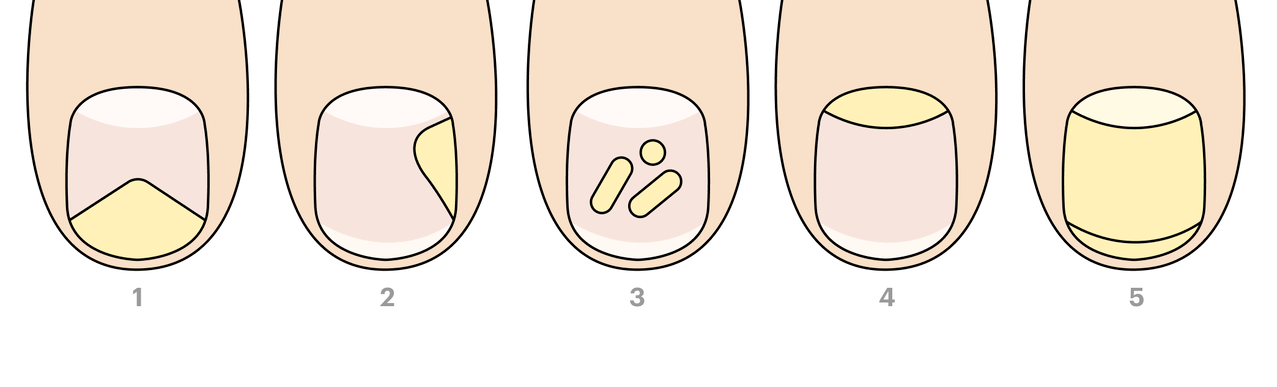 types of toenail fungus