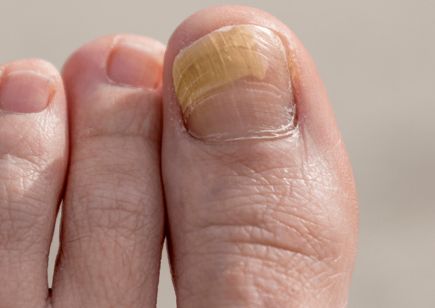 fungus on the nail of the thumb