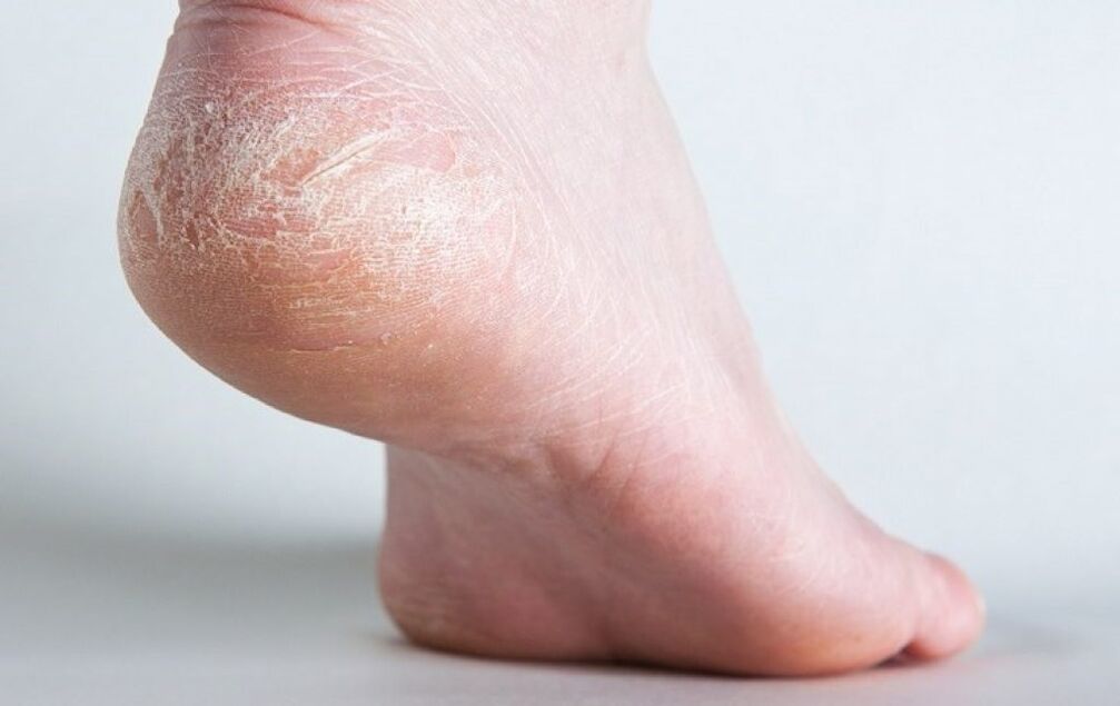 fungus on the skin of the feet